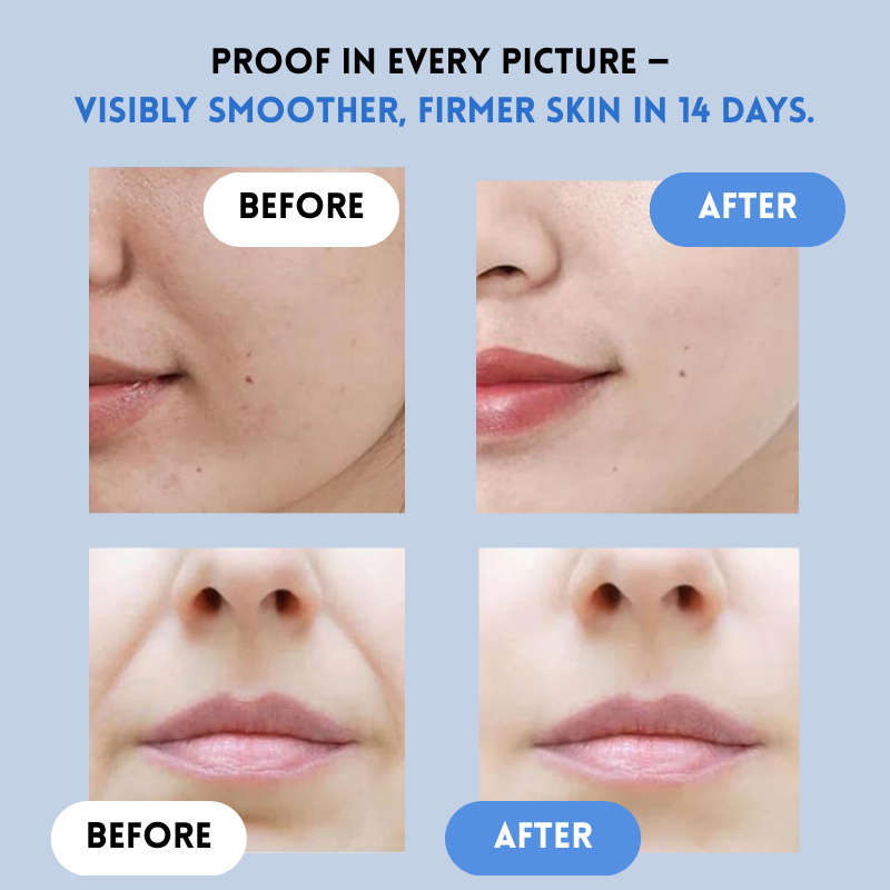 Auralift Renew Strips – The Instant Solution for Timeless Beauty - Buy More Save More