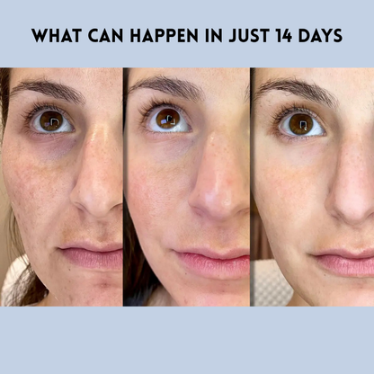 Auralift Renew Strips – The Instant Solution for Timeless Beauty - Buy More Save More