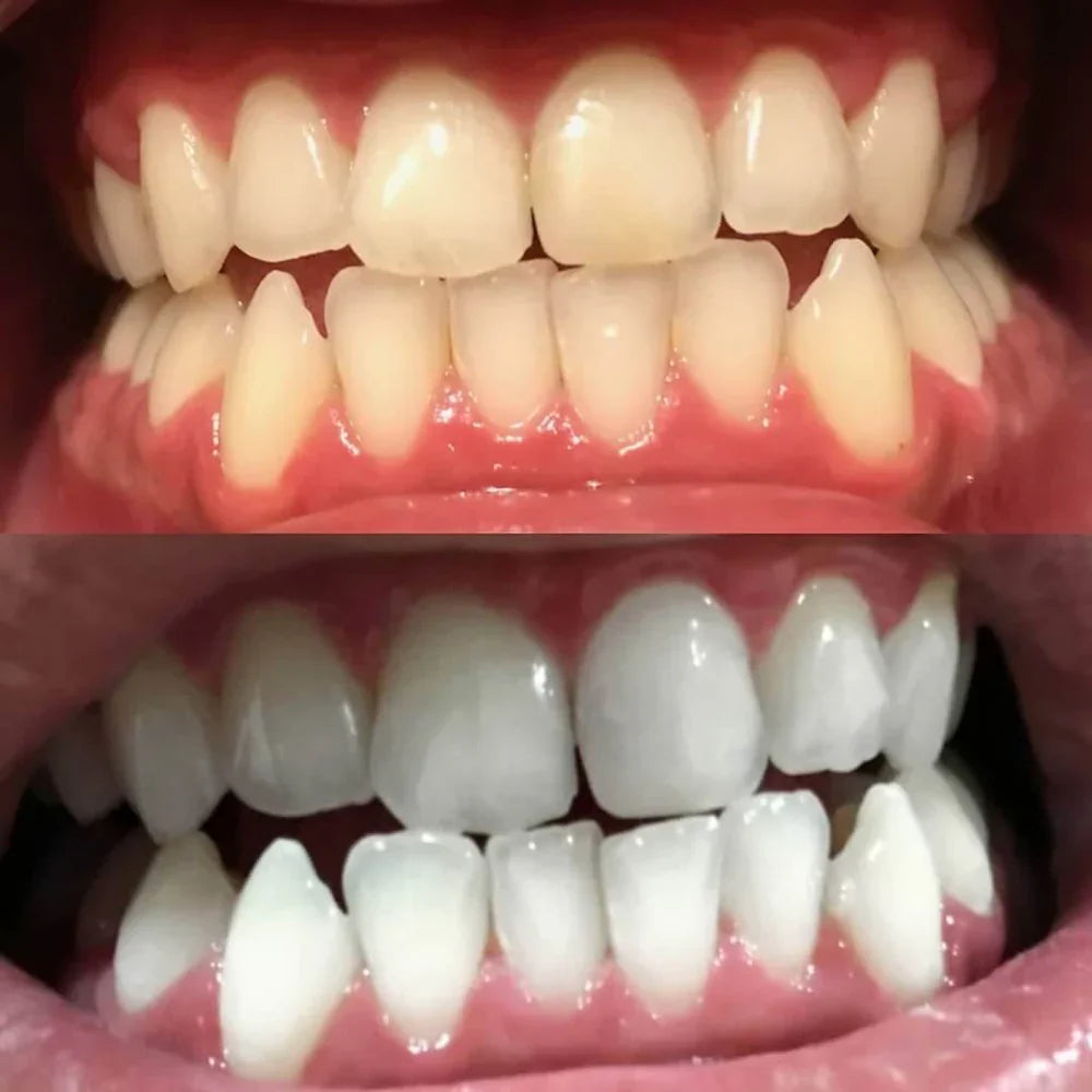BrightPen™ – A Radiant Smile in Minutes 1+1 FREE