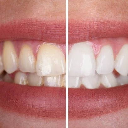 Brillaglo™ — Whitening Gel for a Radiant, Confident Smile